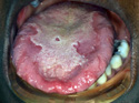 geographic tongue